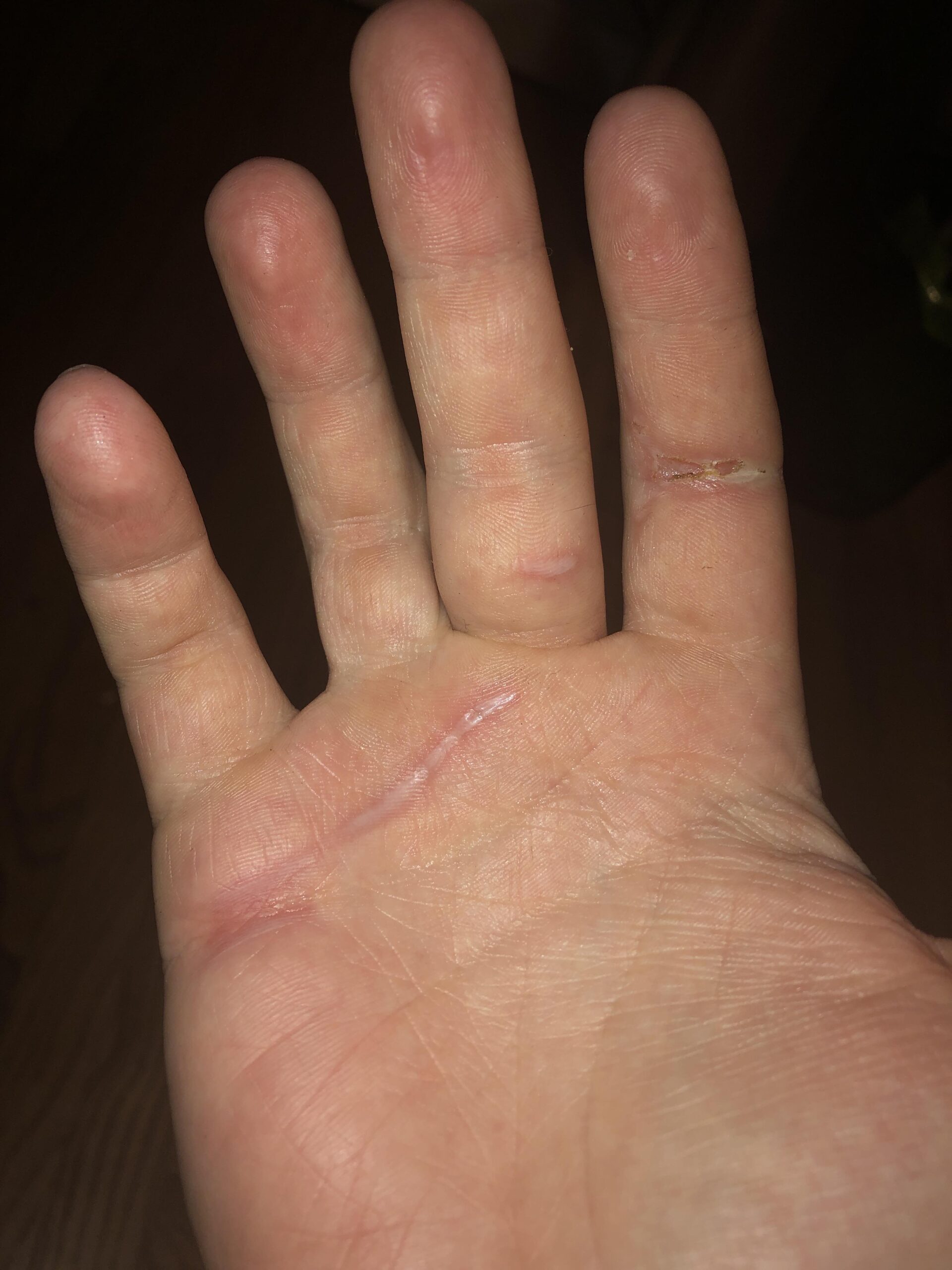 What to Put on Rope Burn from Dog Leash